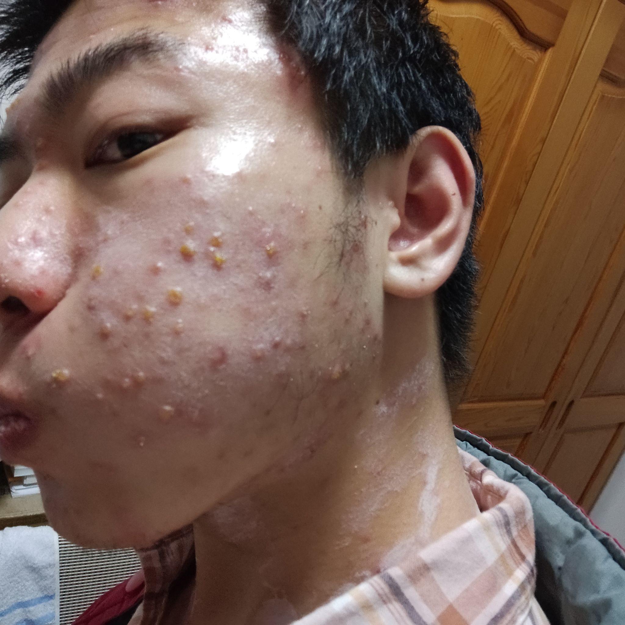 你们出水痘很严重吗? - 知乎