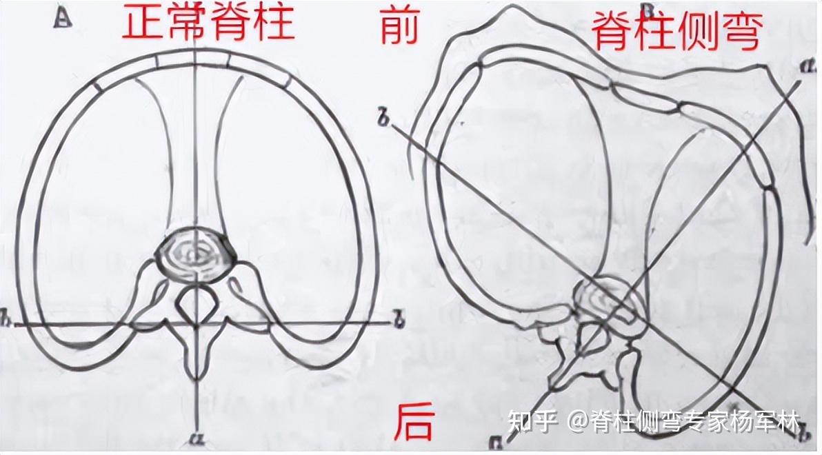 警惕!破坏美感的“剃刀背” ,可能是脊柱侧弯引起的! - 知乎