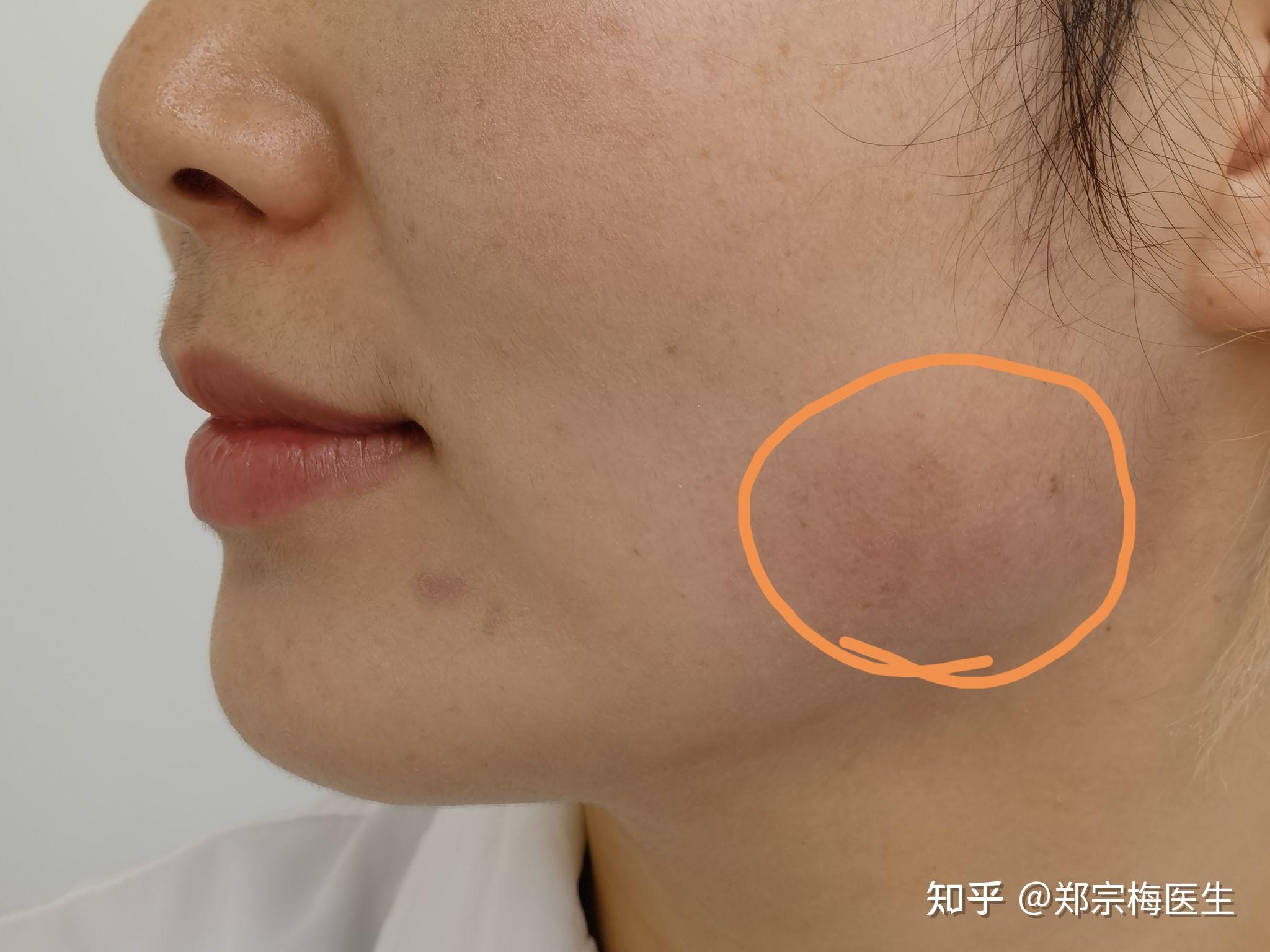 安心变美狂欢季瘦脸meimei美诊为啥我要瘦脸就要上微创瘦脸组合拳