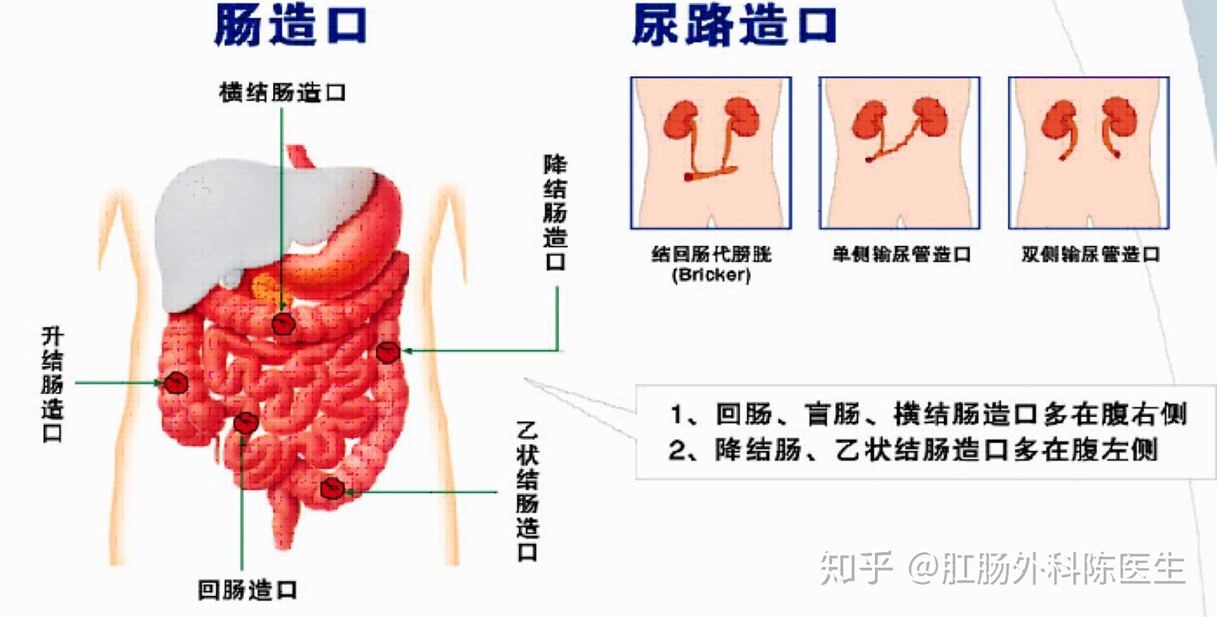 回肠造口位置图片