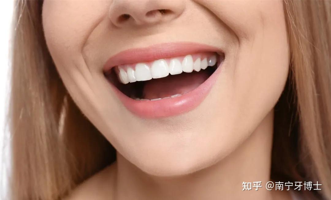 想拥有炫白明星牙吗?『牙齿贴面』为你定制美丽笑容