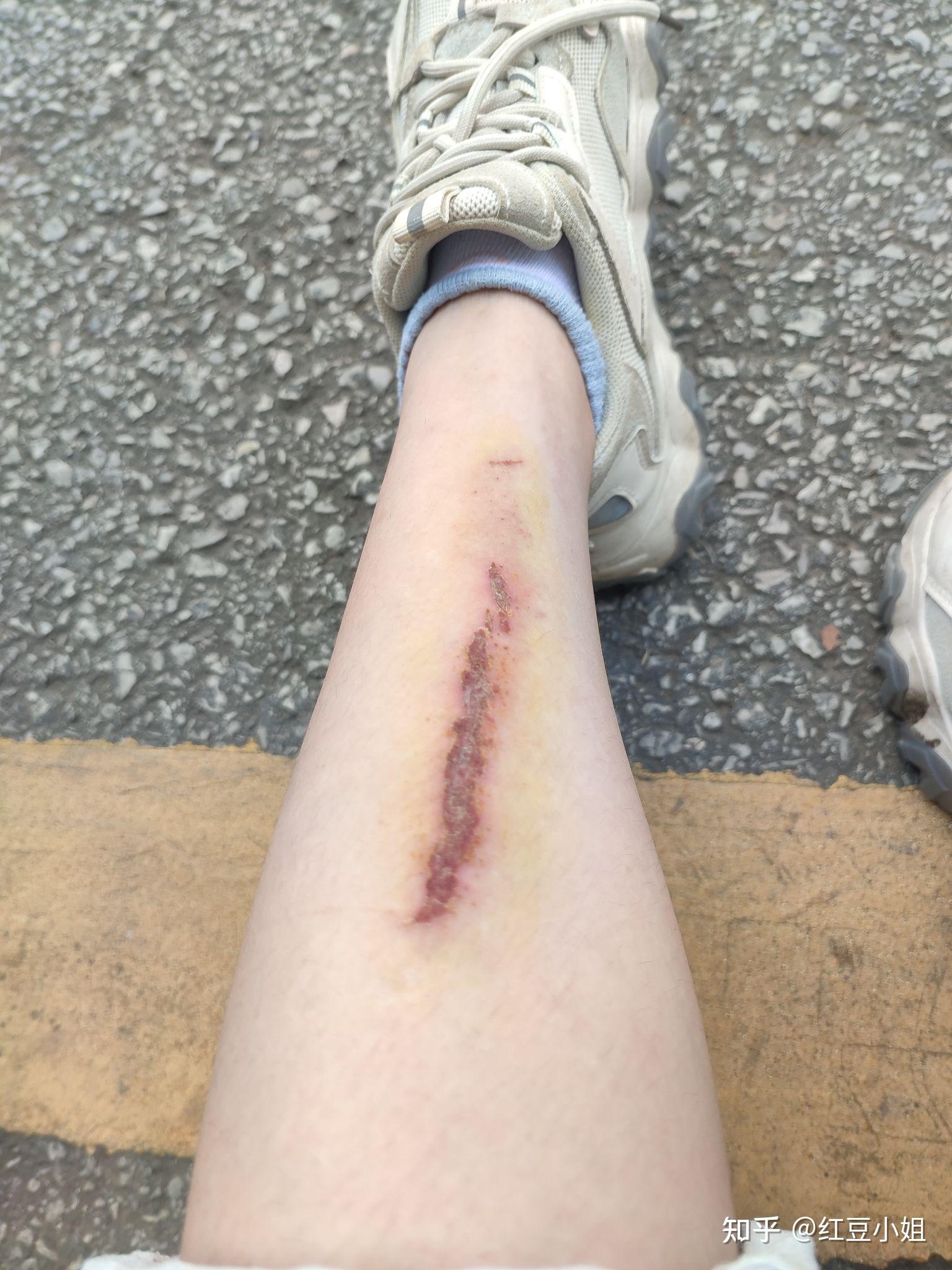 结痂的伤口可以碰水吗