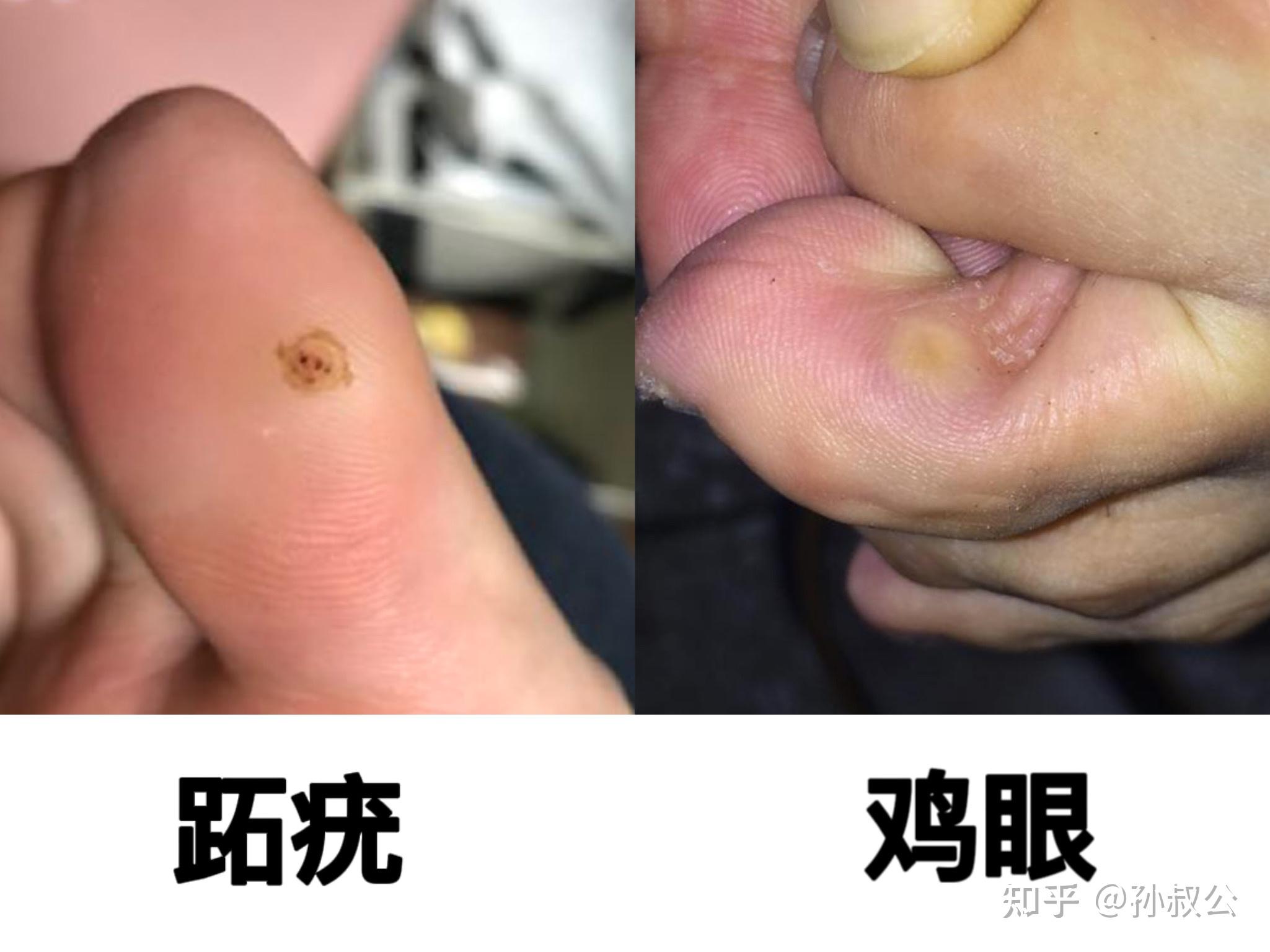 这个是不是鸡眼?