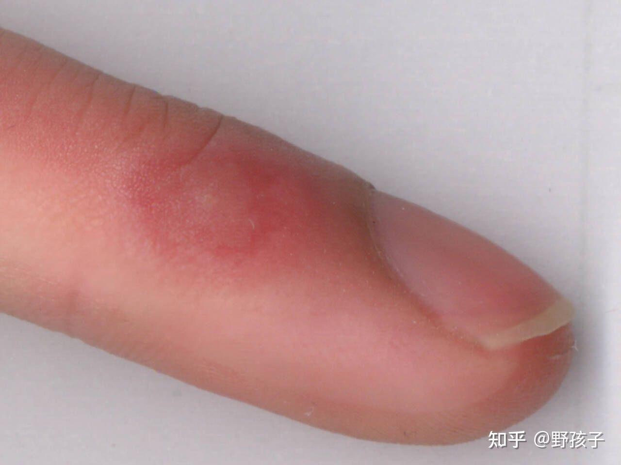 冻疮痒怎么缓解 - 知乎