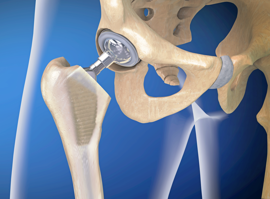 股骨头坏死究竟是哪里坏死早期是否需要治疗存在争议