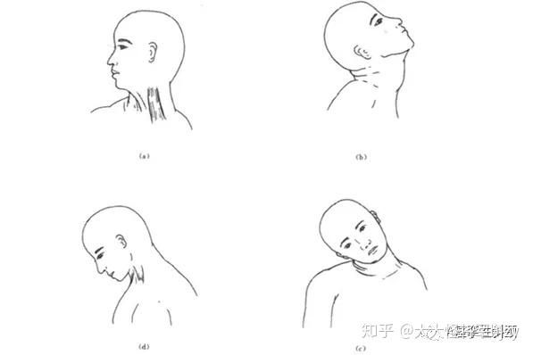 头夹肌,半棘肌同时痉挛或某一两对肌肉痉挛,患者头颈向后过伸,眼睛看