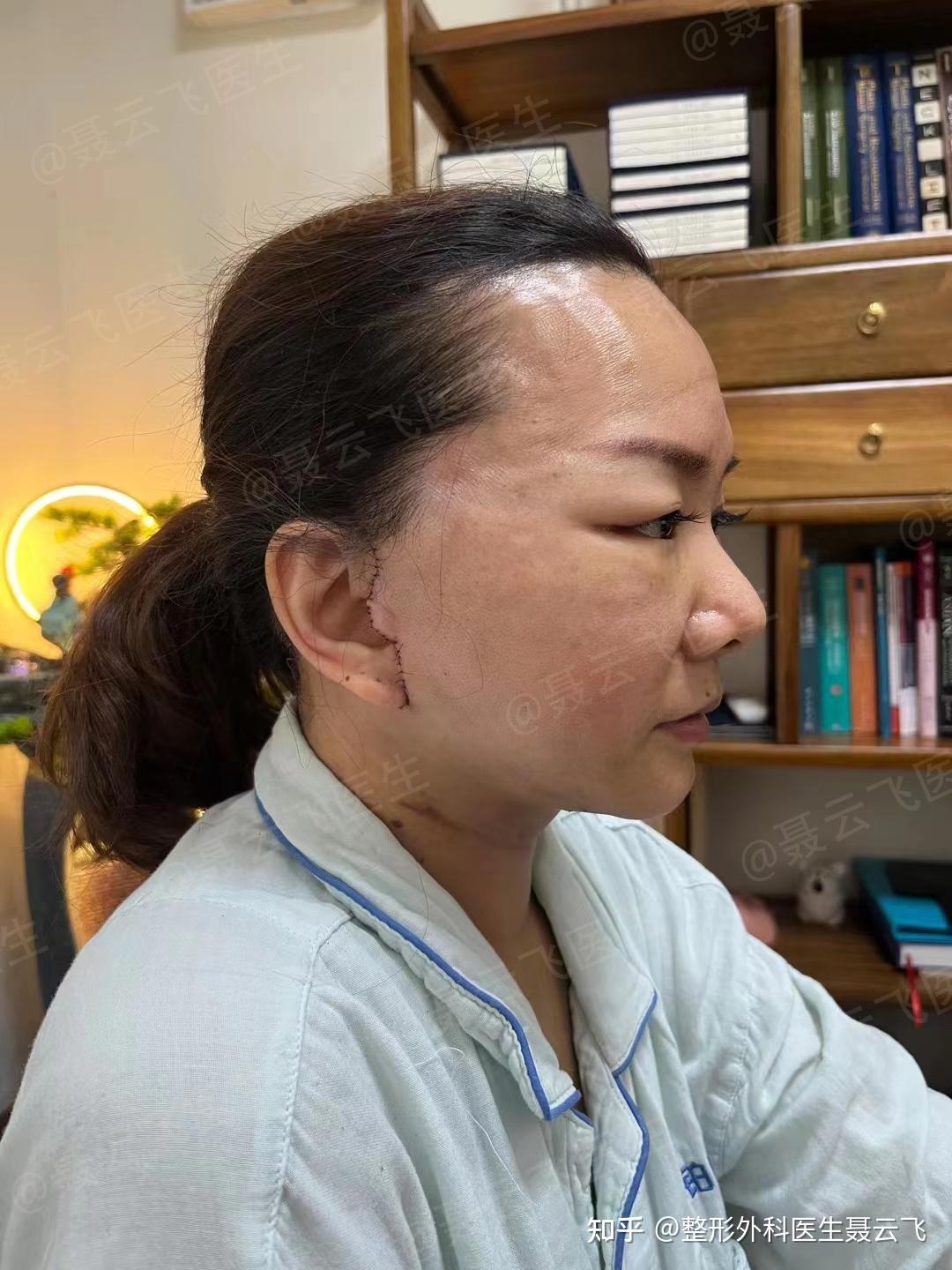 广州拉皮手术效果好的医生? - 知乎