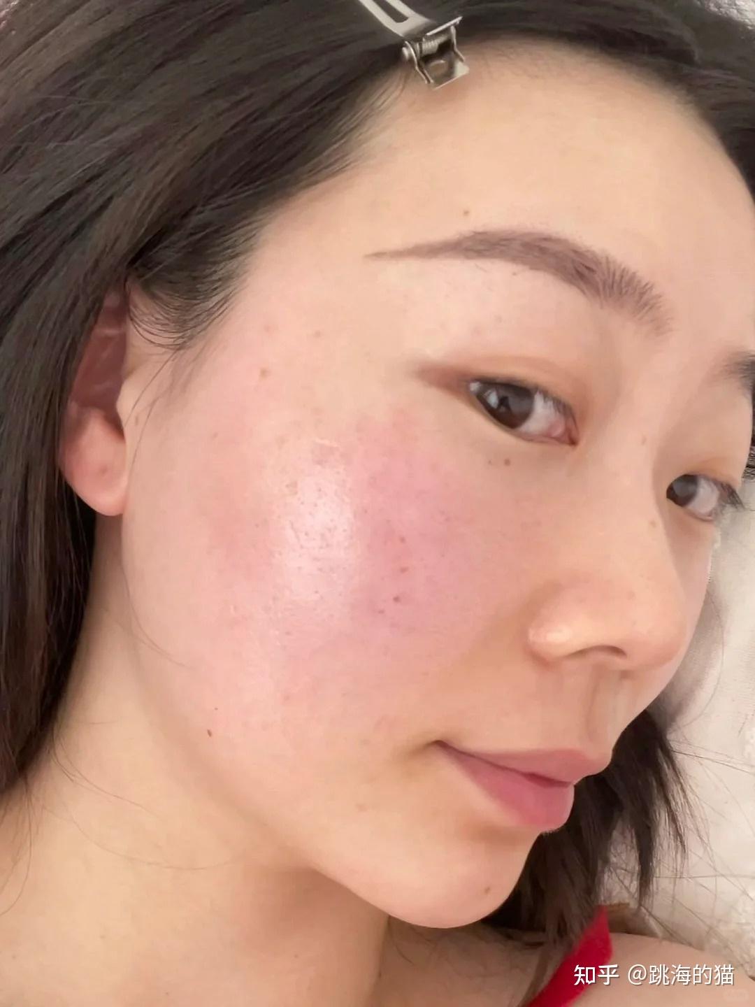 脸泛红怎么更快修复?