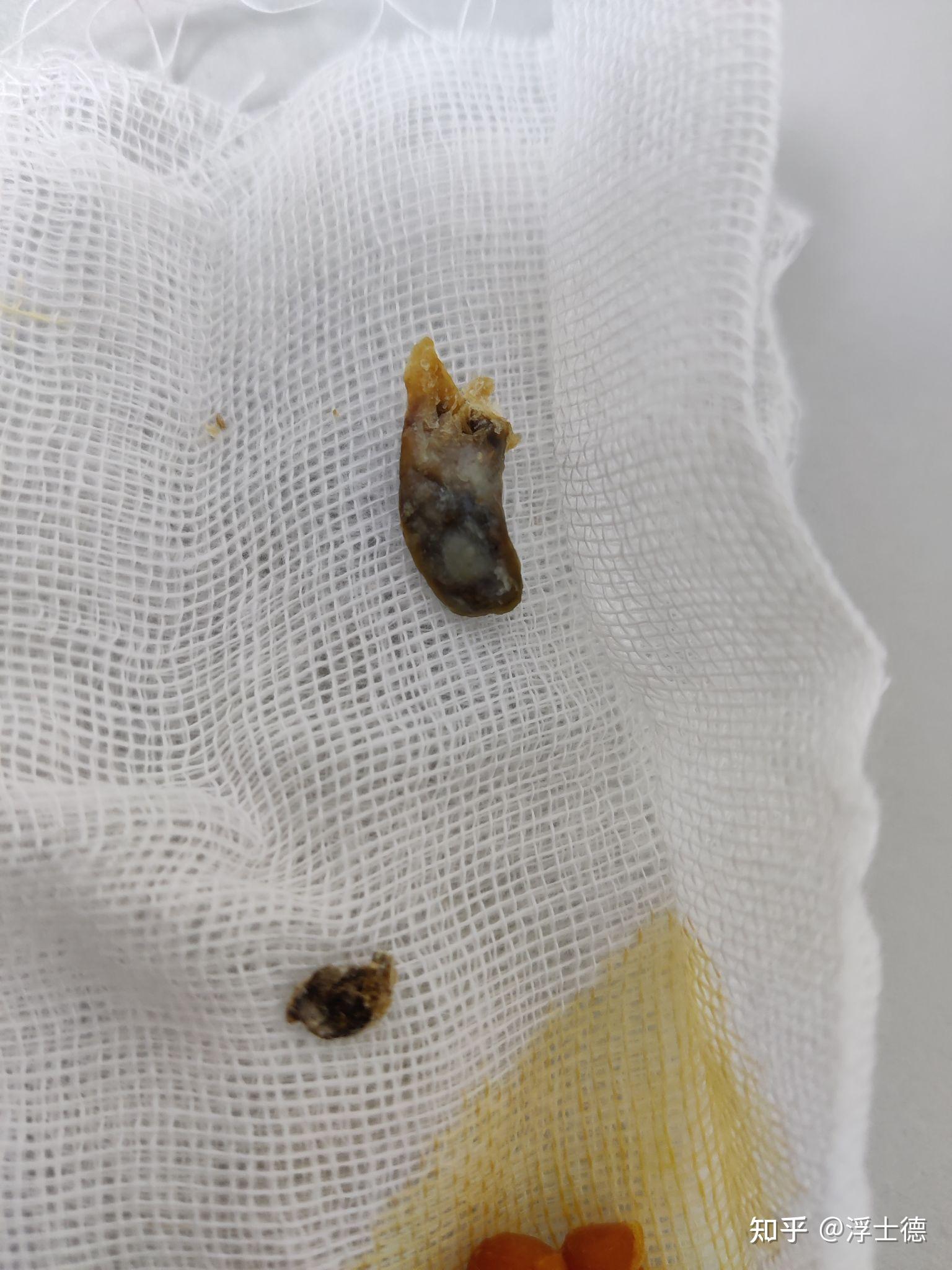 为什么我从来没掏出来过大号的耳耵聍