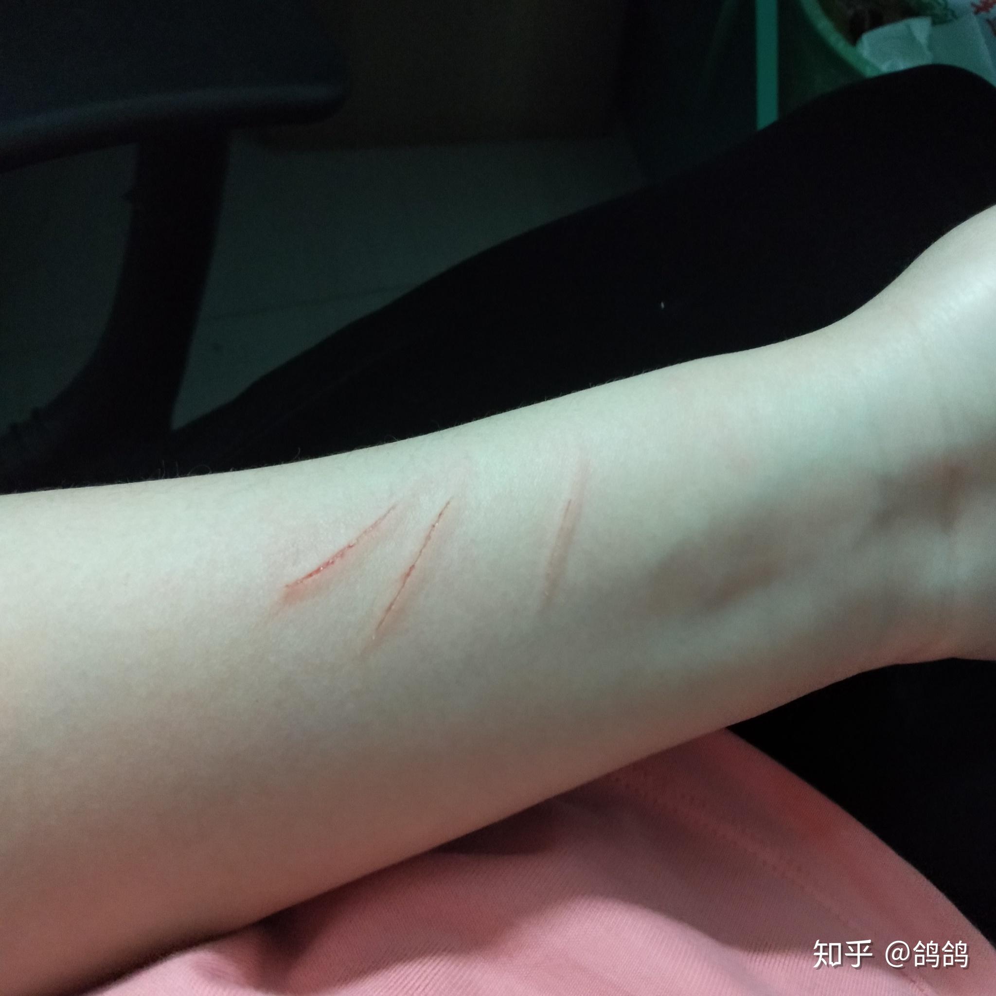 被自己家养的小狗抓伤了,要不要打狂犬疫苗呢? - 知乎