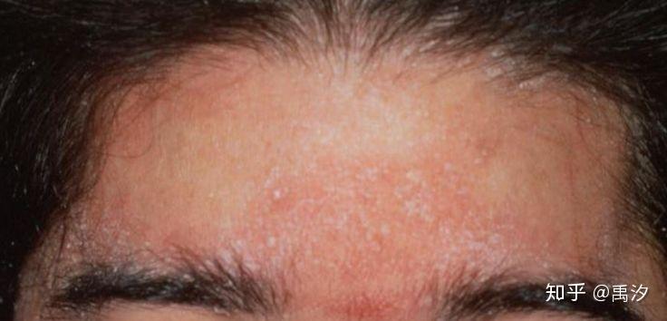 请问头部脂溢性皮炎产生的大块白色片状鳞片到底是什么