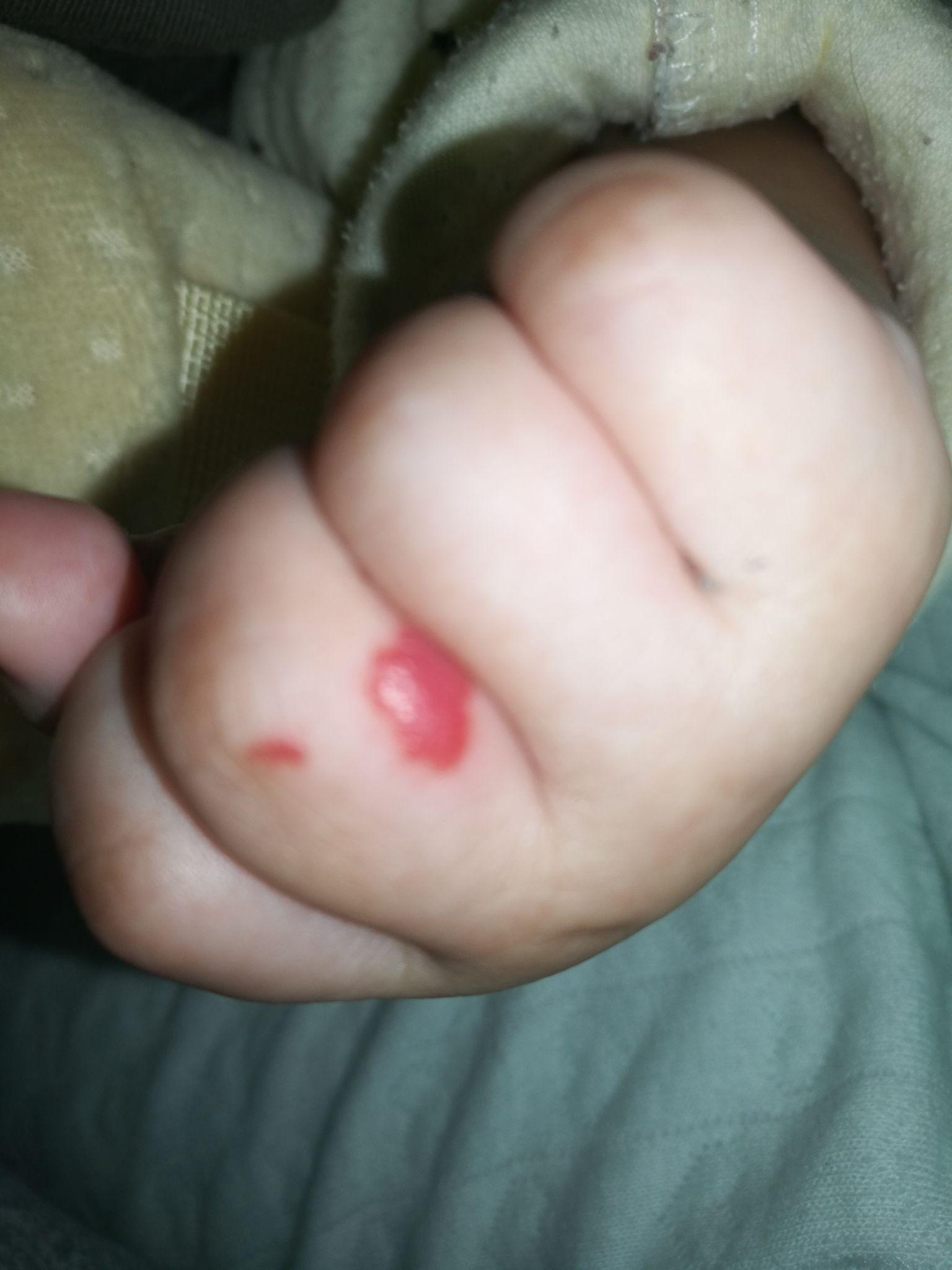 宝宝手指长血管瘤图片图片