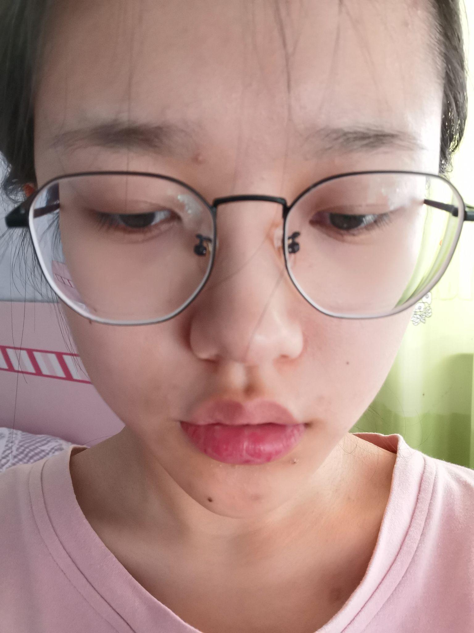 上嘴唇上翘,上翻怎么办?侧面看起来简直丑哭我!