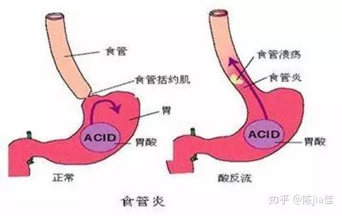 咽喉下端堵感梗阻感 - 知乎