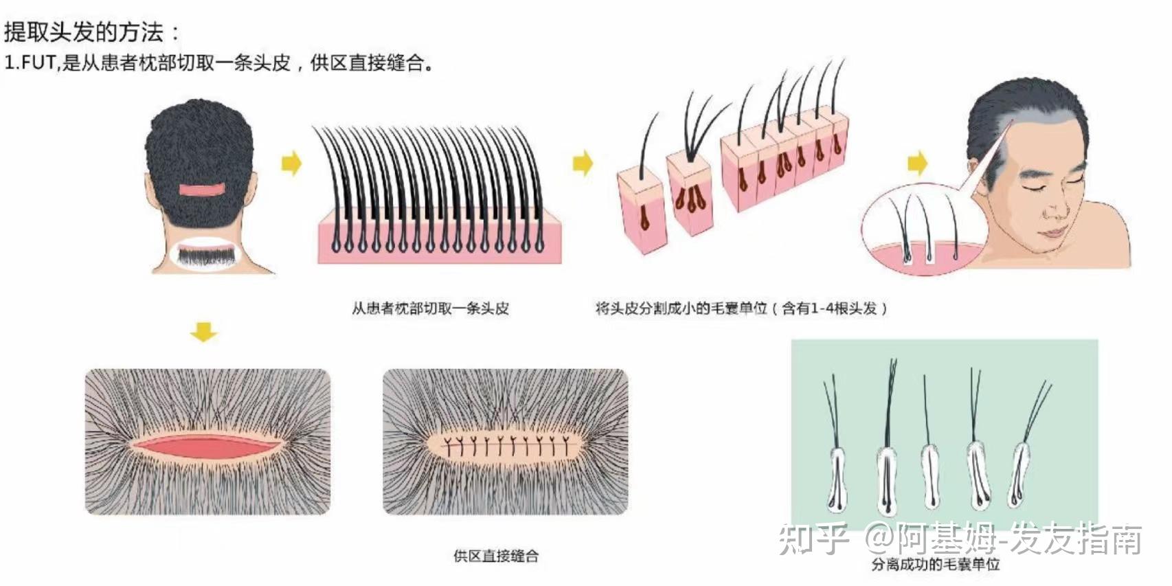 蒙城植发机构(头顶植发大概要多少钱)