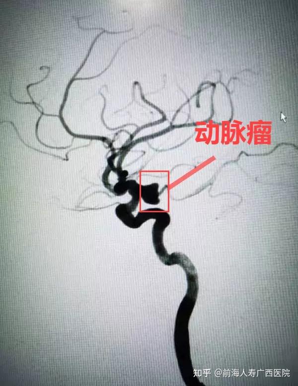 前海人寿广西医院神经外科完成一例复杂巨大颅内动脉瘤介入手术