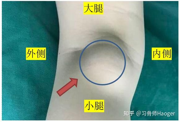 膝盖后面腿窝凸起图片