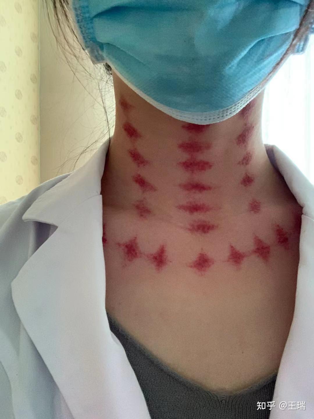 为什么说拔罐拔出来的黑紫色印记是毒素呢