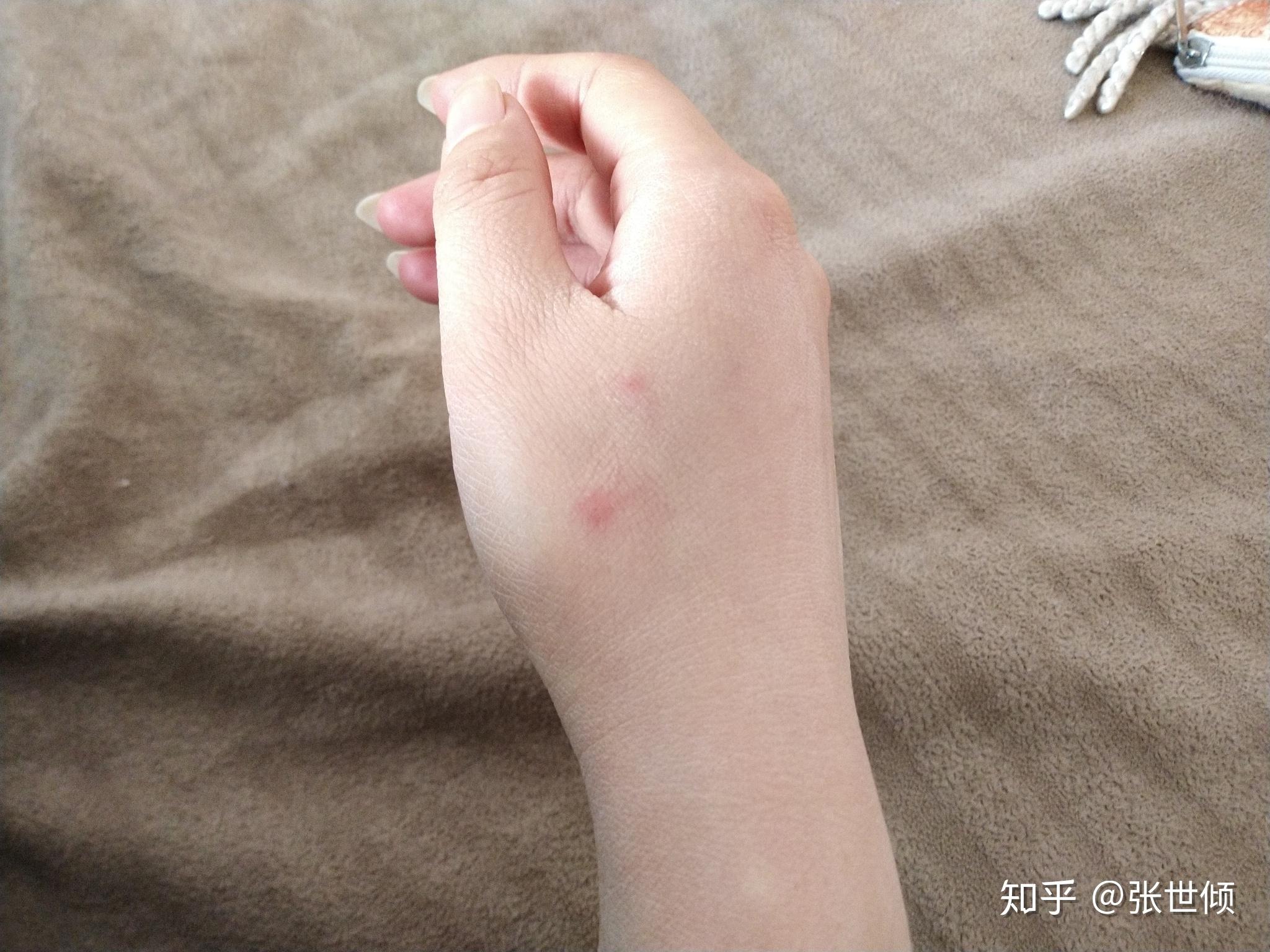 昨天晚上被流浪猫抓伤伤口很小几乎看不见但是渗出一点血需不需打疫苗