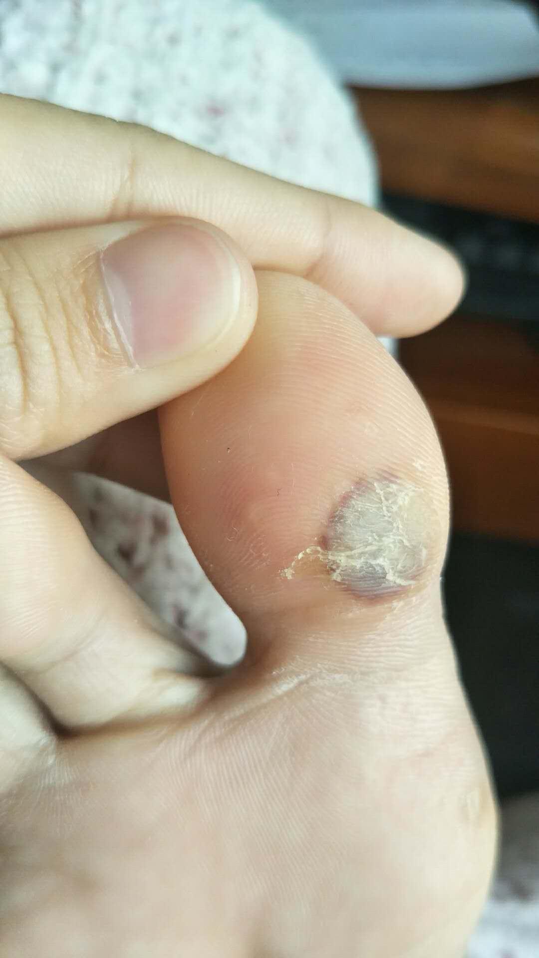跖疣的透明角质怎么一直除不掉? - 知乎