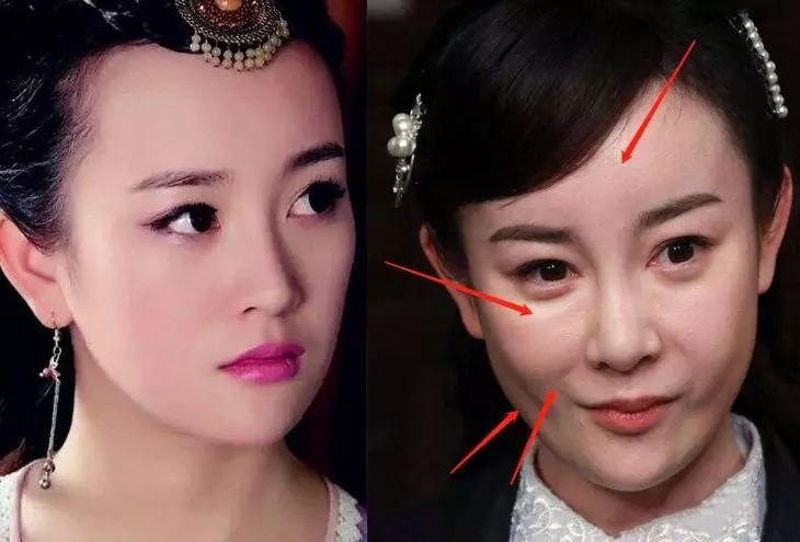 她可能只是想去做一个苹果肌的填充,没想到填充过度,变成了这样