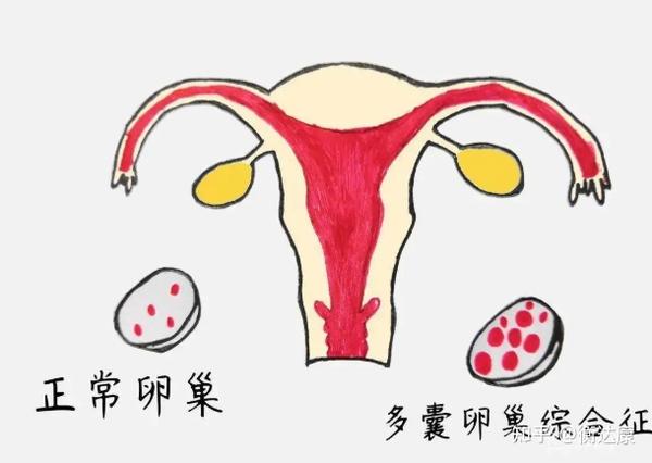 多囊卵巢的女性如何科学备孕?这些方法能够有效提升受孕率 - 知乎