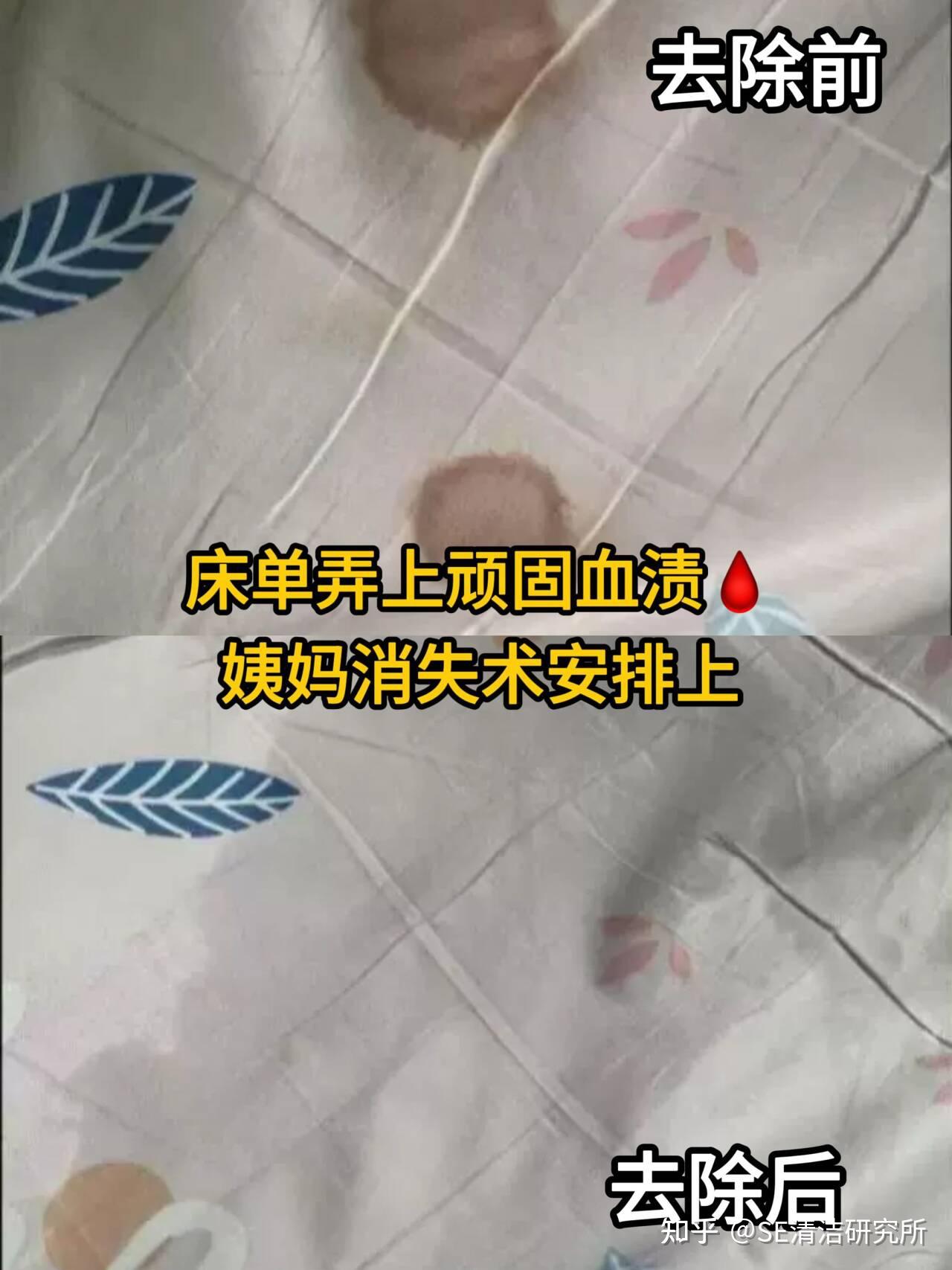 如何轻松去除床单血渍? - 知乎