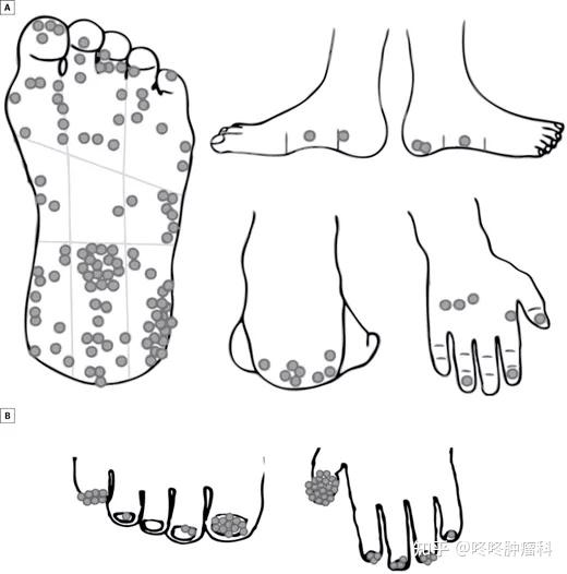警惕身上的定时炸弹! 这类「黑痣」癌变风险非常高, 最好及时切除