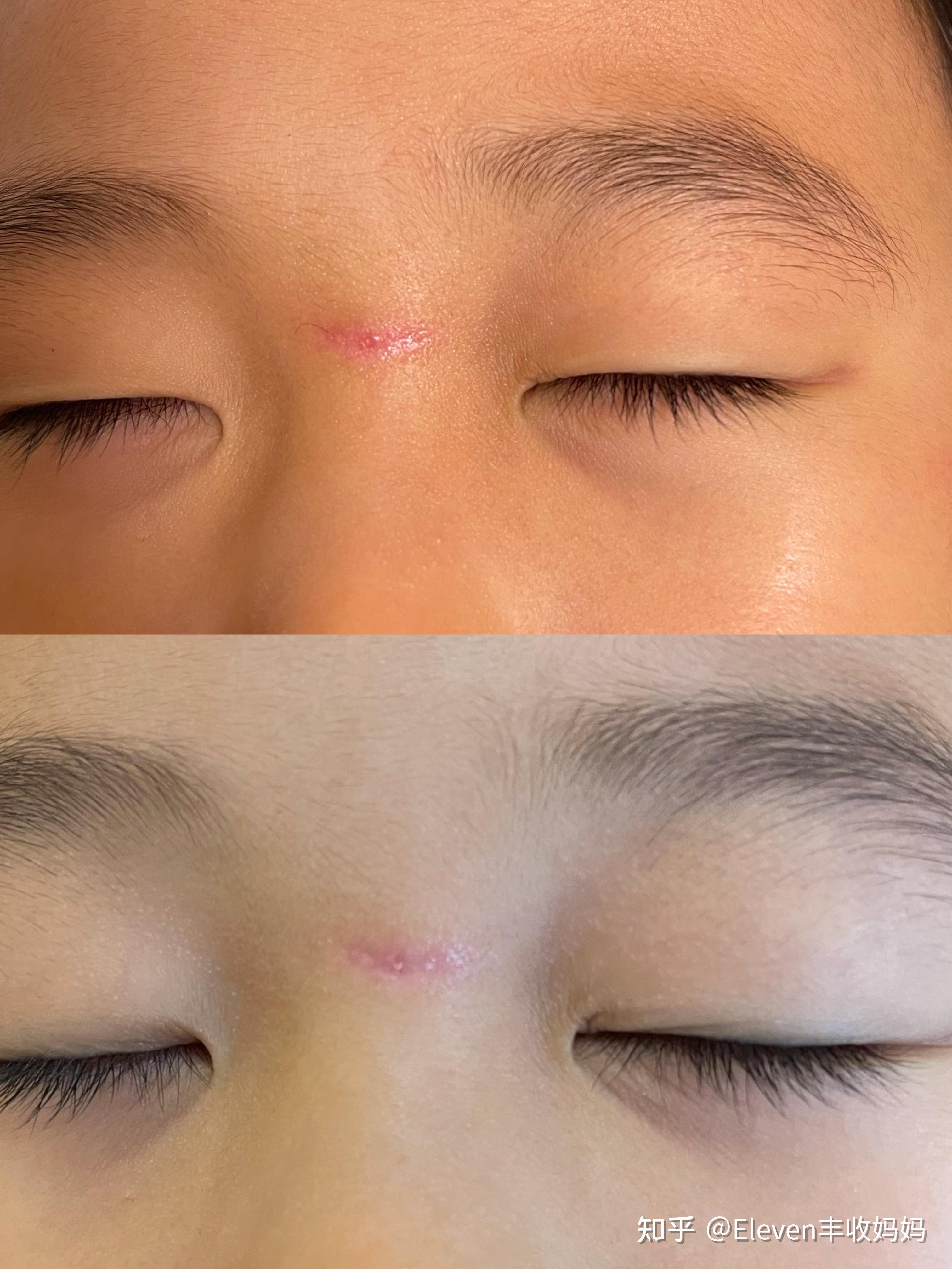 脸上缝针疤痕怎么去除