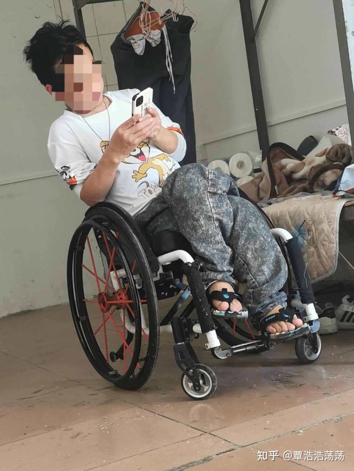 我是一个小儿麻痹症的患者,今年24岁,前一段时间看到文章说小儿麻痹