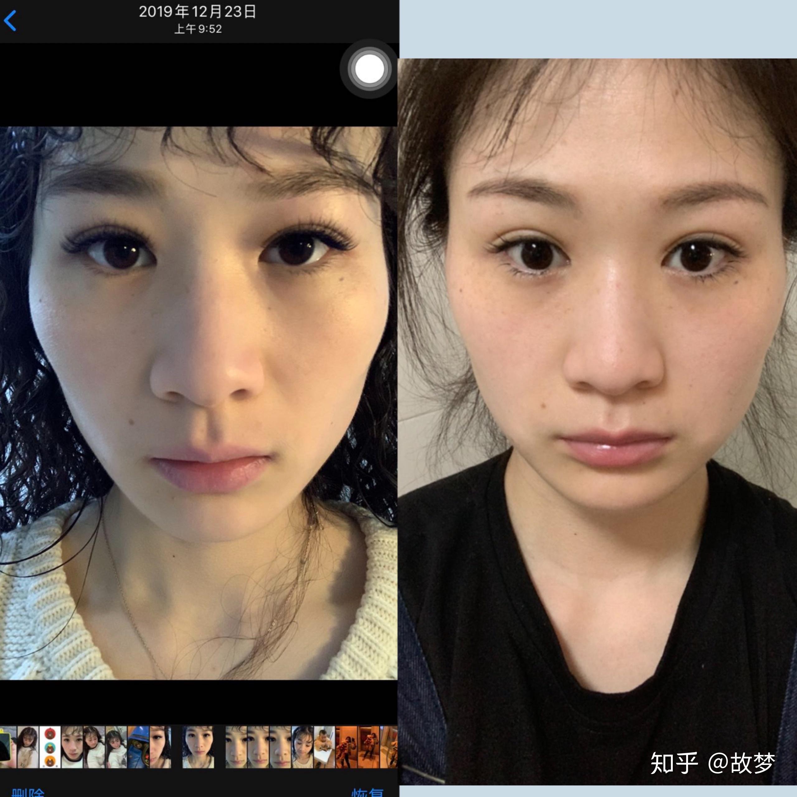 颧骨一高一低后天除手术外如何改善