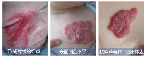 草莓状血管瘤的五大危害 知乎 草莓状血管瘤的五大危害 知乎