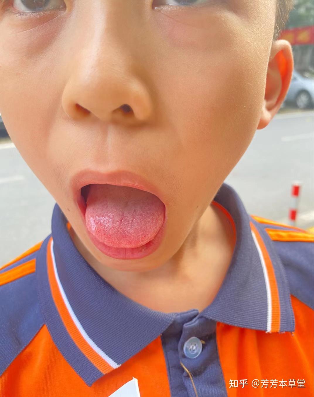發燒先看舌頭！孩子張口見「草莓舌」快送醫 醫：有3致命疾病 | ETtoday健康雲 | ETtoday新聞雲