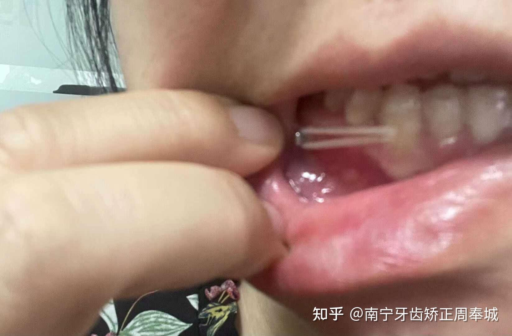 牙套皮筋的力度与图案图片