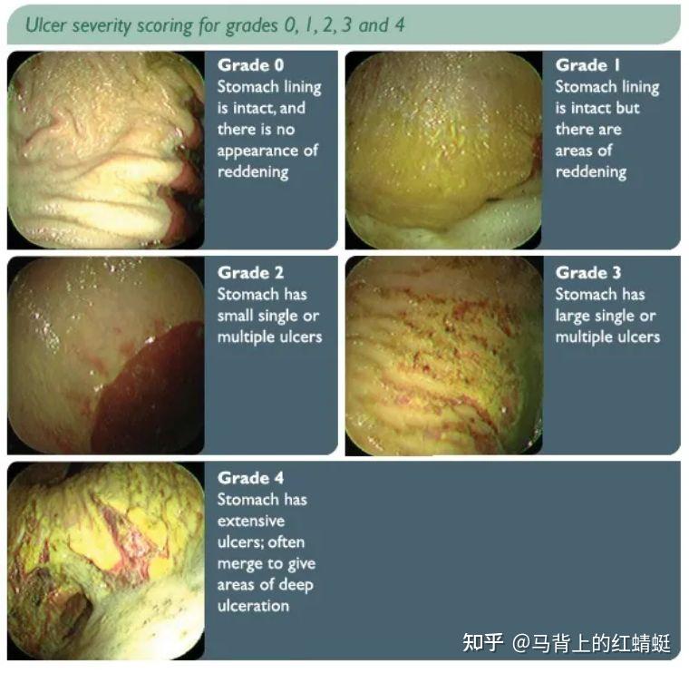 自然科学马胃溃疡综合症如何进行评分分级如何治疗