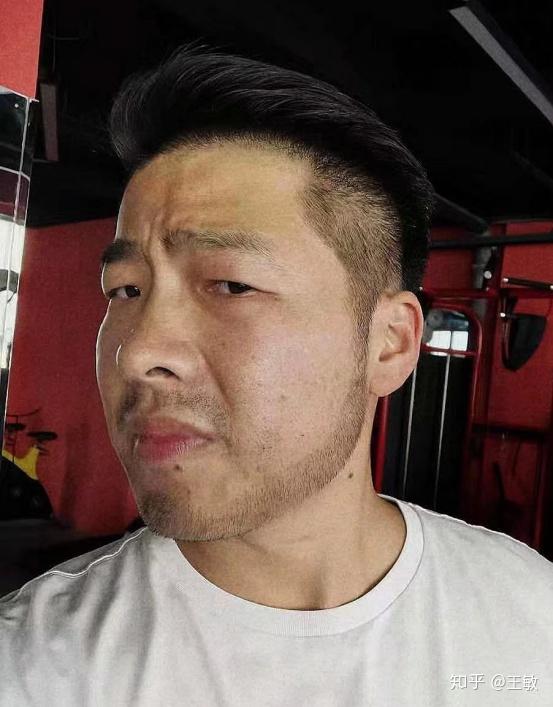 植发一个毛囊单位多少钱头顶加密天生发际线高眉毛稀疏植发具体多少钱
