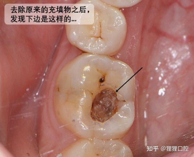 關於補牙假如幾年後填充物掉了再次補的話是不是又要磨一次牙會不會磨