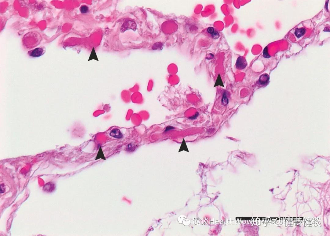 新冠患者的肺泡毛细血管中的多个微血栓(箭头处)