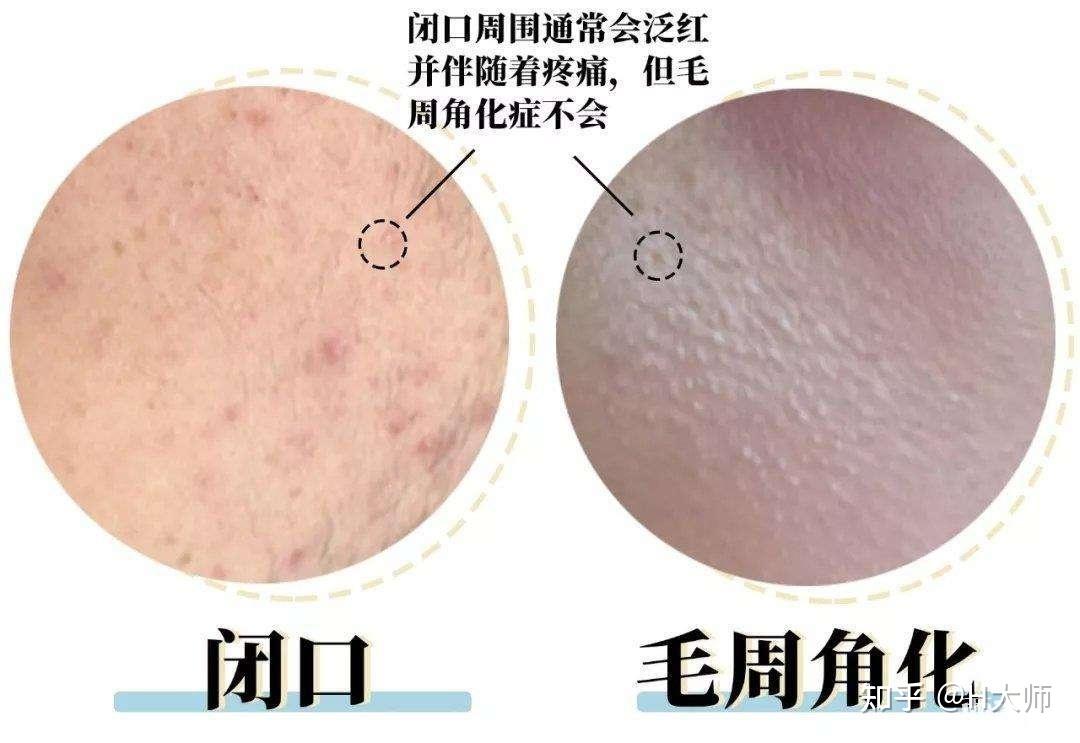 ①果酸身体乳对有疙瘩和鱼鳞皮的类型,效果还不错,但是含酸对发红类型