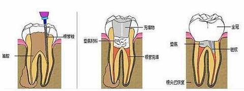 牙齿打桩