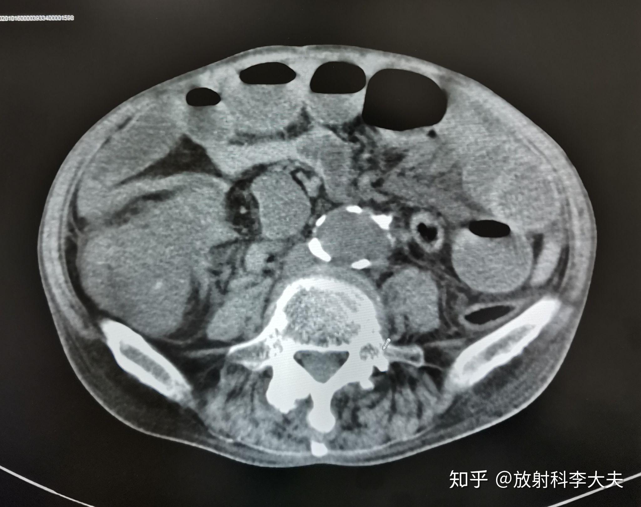 結腸癌早發現早治療生存率非常高