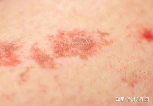 IFPA芳疗师讲——柑橘精油的光敏性是如何发生的? - 知乎