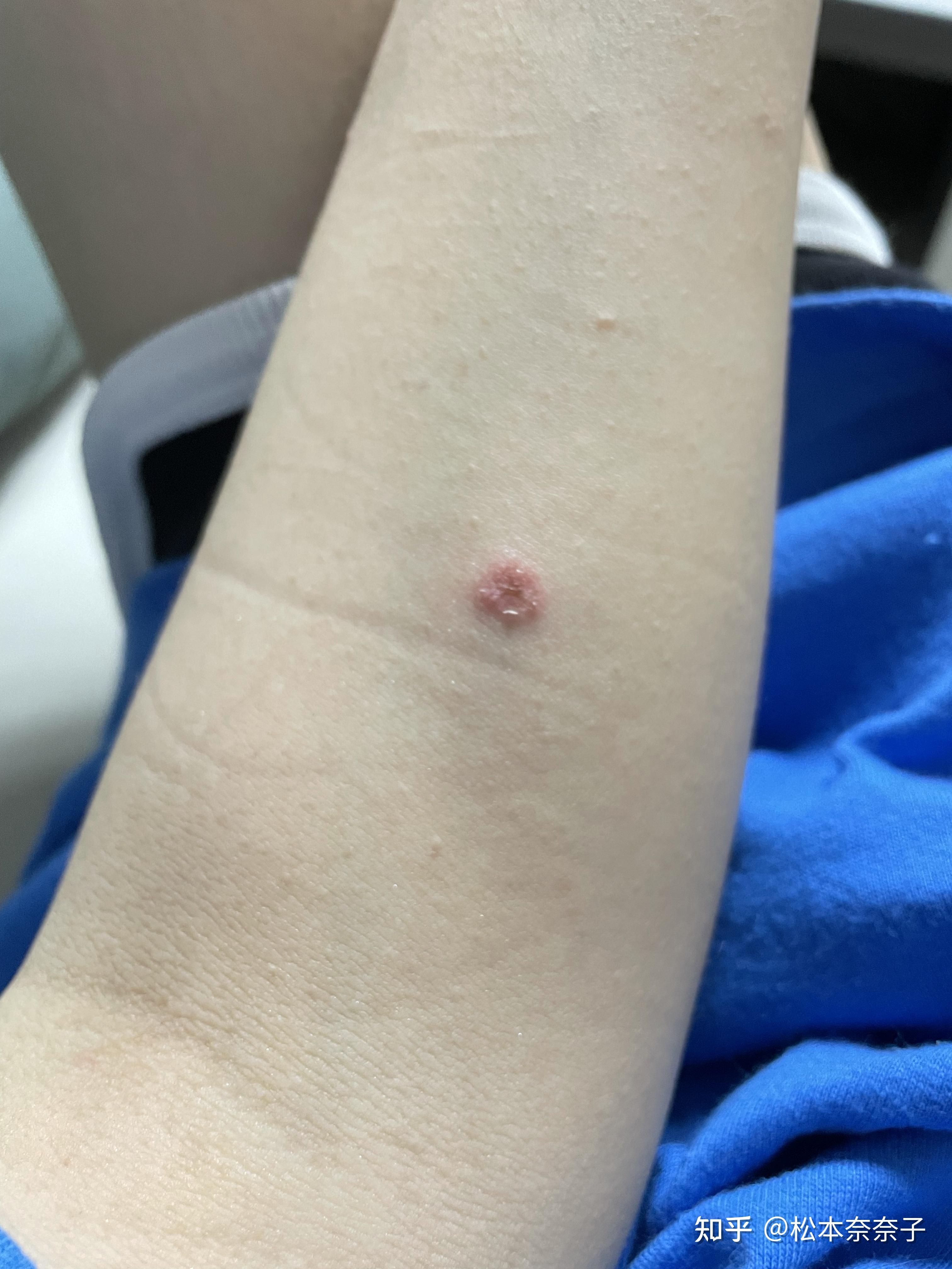 人长猫藓什么样子? - 知乎