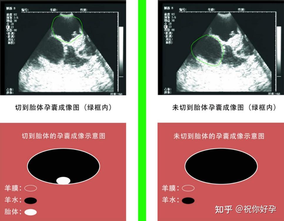 遇到物体又被反射回来,经过处理,由于声抗阻值不同形成不同灰度的图像