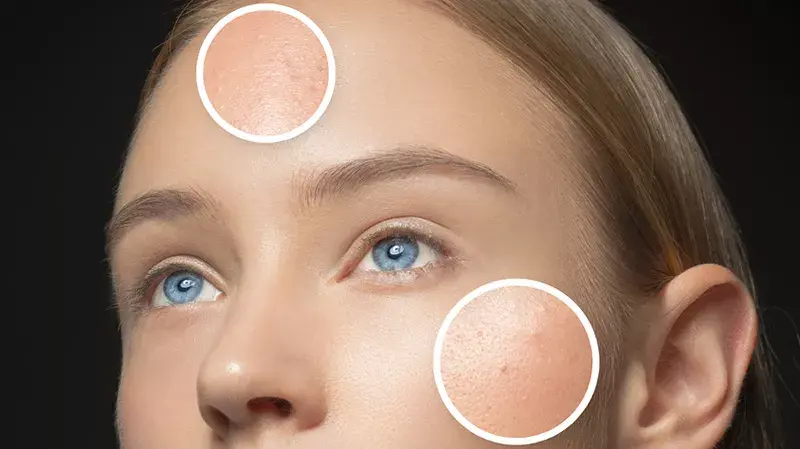 如何减少油性皮肤的油脂产生?