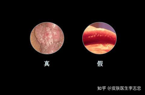 尖锐湿疣短期内就会有形态上的改变,呈单发或者多发乳头状,菜花状