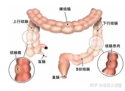 直肠癌 腹痛 怎么个痛法 成都肛肠专科医院 公立 成都肛肠医院 成都肛肠医院太升路 四川省肛肠医院