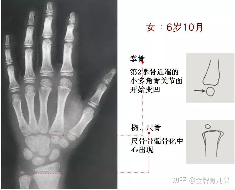 如何看骨龄图片