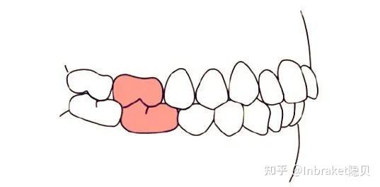 正畸科普 I 看看你的牙齿属于哪一类? - 知乎