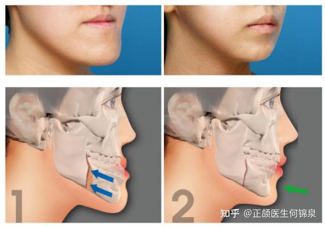 2,第二种短下巴的地包天由于下颚比上颚大且下颚小,所以需要将上颚